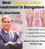 Best Varicose Veins Treatment in Bangalore