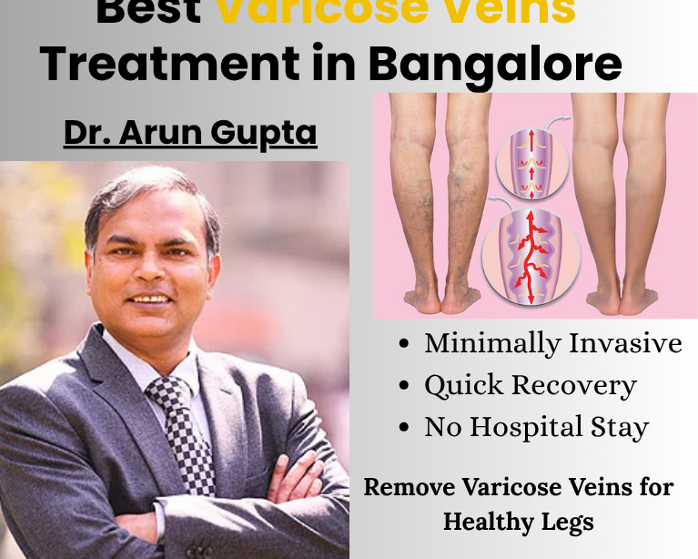 Best Varicose Veins Treatment in Bangalore