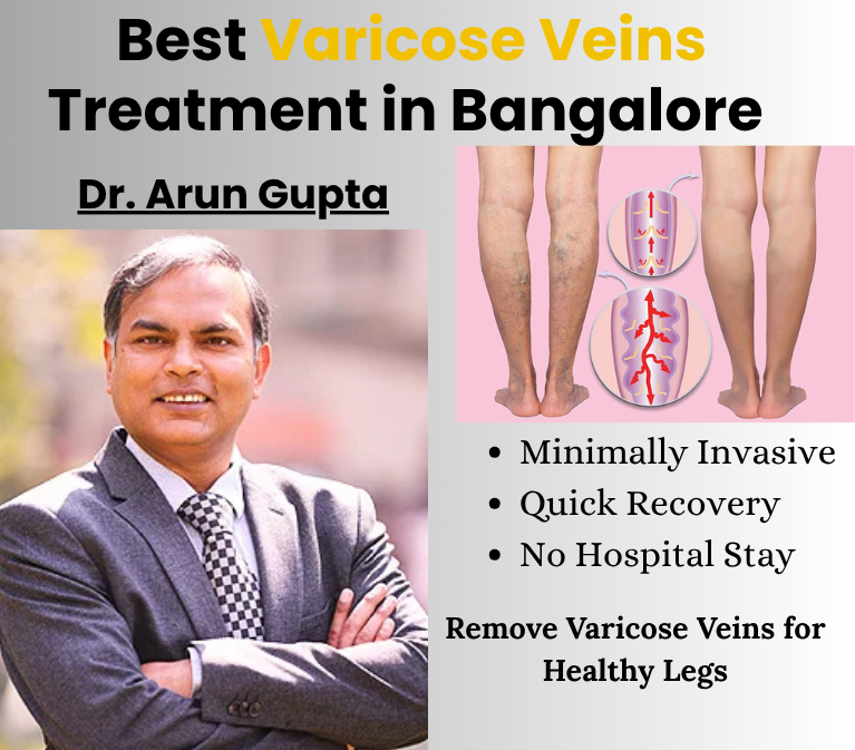Best Varicose Veins Treatment in Bangalore