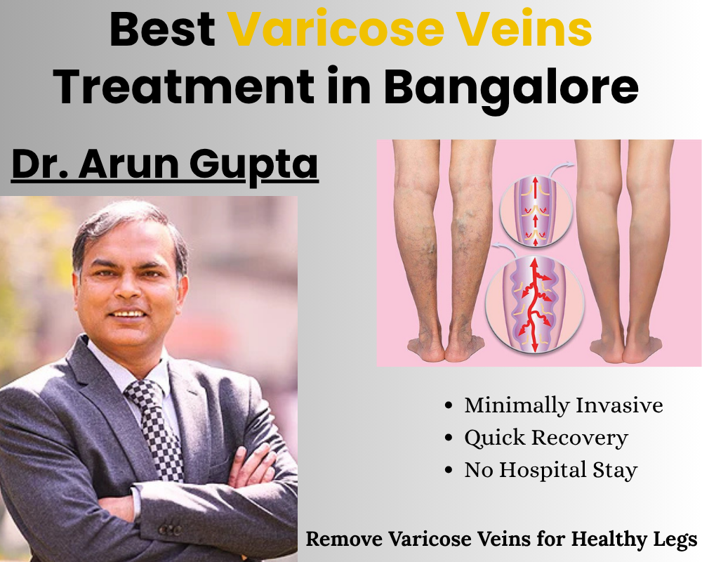 Best Varicose Veins Treatment in Bangalore