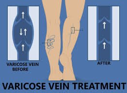 Best Varicose Veins Treatment in Bangalore