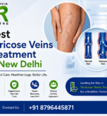Best Varicose Veins Treatment in New Delhi