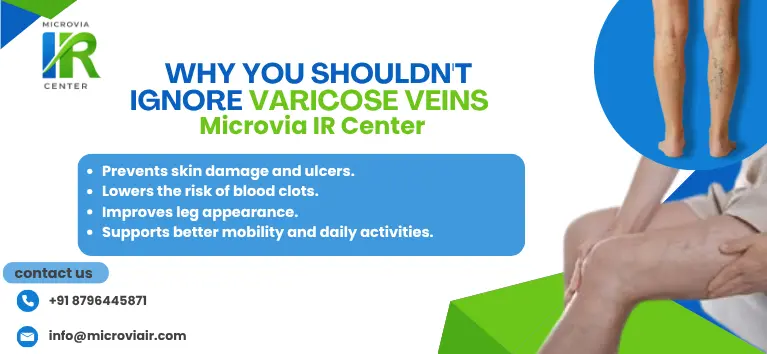 Why You Shouldn't Ignore Varicose Veins