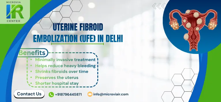 Uterine Fibroid Embolization (UFE) in Delhi