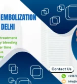 Uterine Fibroid Embolization (UFE) in Delhi